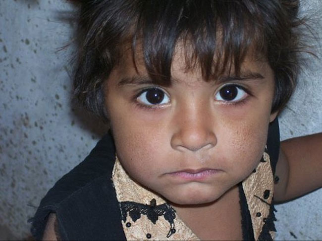 Una bambina accolta in un centro di Msf a Jamshoro, cittadina che si trova a una ventina di chilometri da Hyderabad e a 150 chilometri a nordest di KarachI.